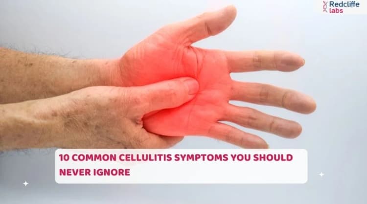 10 Common Cellulitis Symptoms You Should Never Ignore