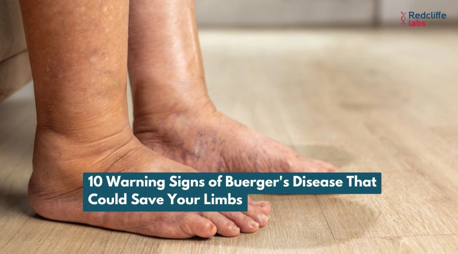 10 Warning Signs of Buerger's Disease That Could Save Your Limbs