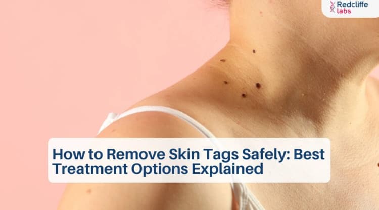 How to Remove Skin Tags Safely: Best Treatment Options Explained
