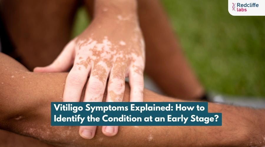 Vitiligo Symptoms Explained: How to Identify the Condition at an Early Stage?