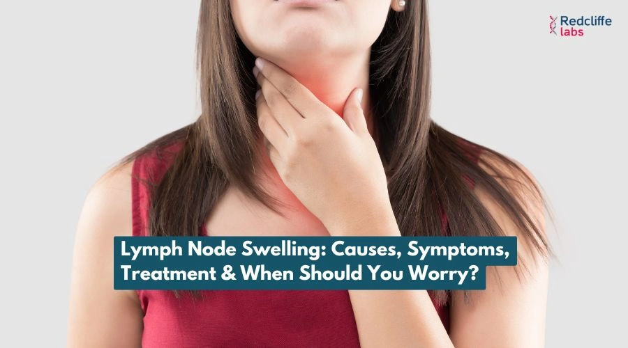 Lymph Node Swelling: Causes, Symptoms, Treatment & When Should You Worry?