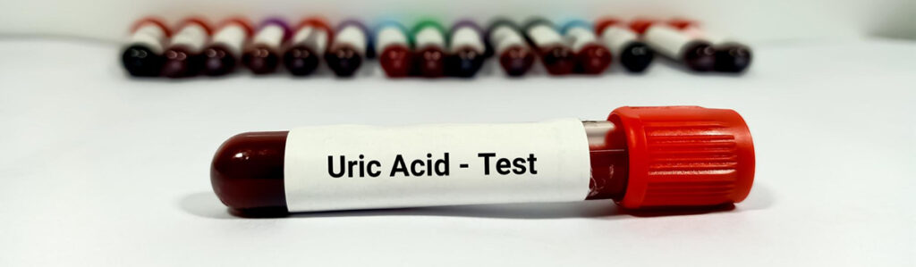 Uric Acid Test – Redcliffe Community