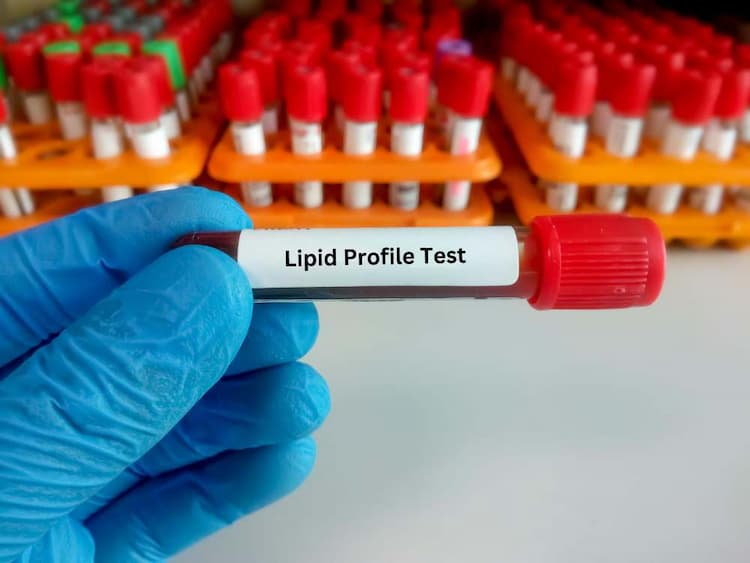 लिपिड प्रोफाइल टेस्ट द्वारे कोणते रोग सापडतात?