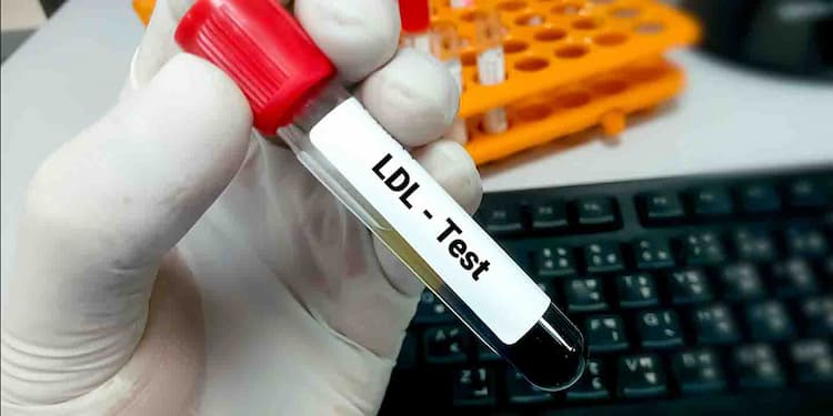 Lipoprotein (a) Blood Test: what is it used for, normal range, and more