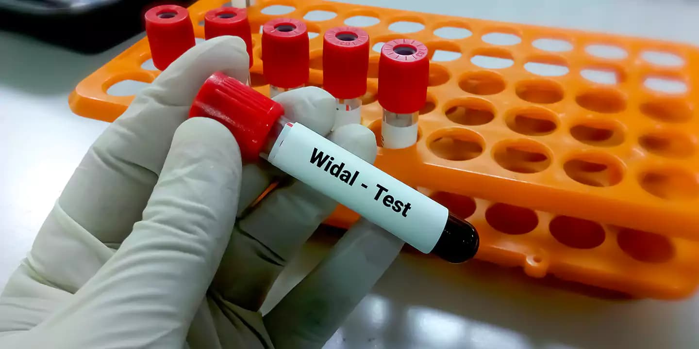 Widal Test - Introduction, Principle and Procedure