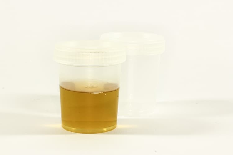 Epithelial Cells in Urine: normal range, what it's results indicate