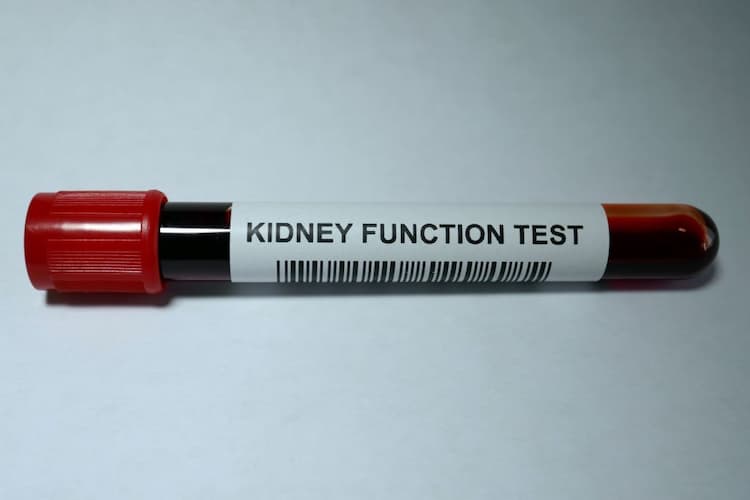 KFT Test List: Imaging Tests Done to Check Kidney Functions