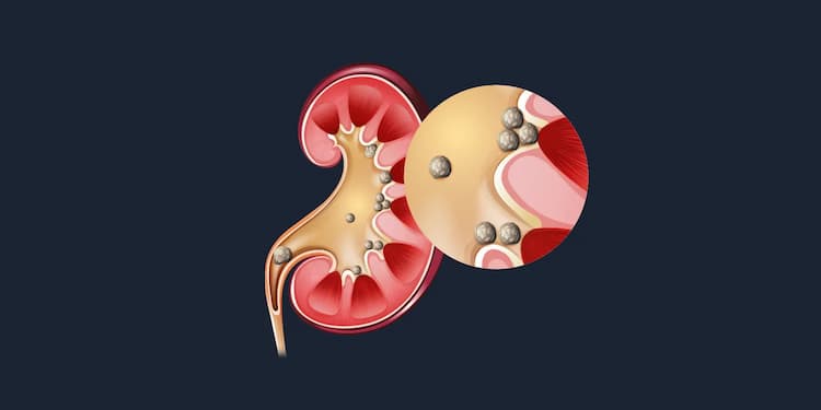 Kidney Stones: its symptoms, causes, and treatment