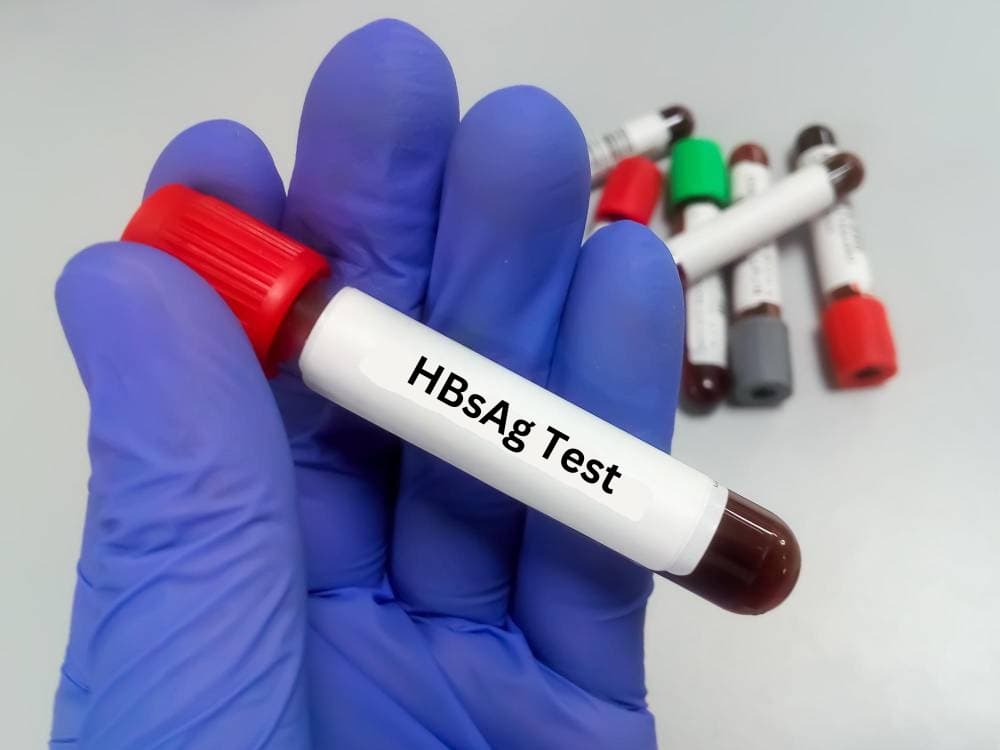 HBsAg test