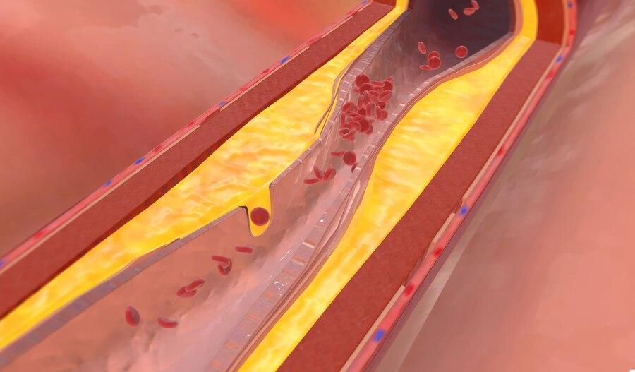 Cholesterol Test