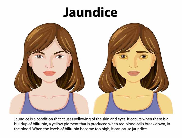 Is Jaundice Contagious? Check the Facts