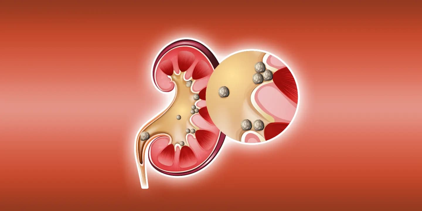 Kidney Stone - What are the things need to avoid in your food
