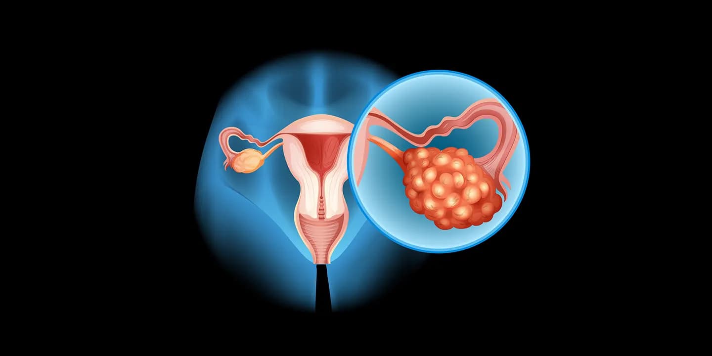 What is ovarian cancer? signs, symptoms, test and treatment