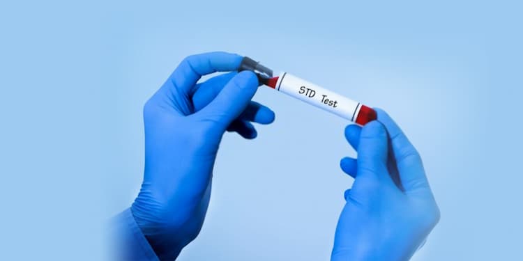 Sexually Transmitted Diseases: Lab tests to diagnose STDs
