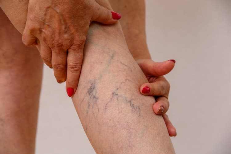 What Is Deep Vein Thrombosis Or DVT?