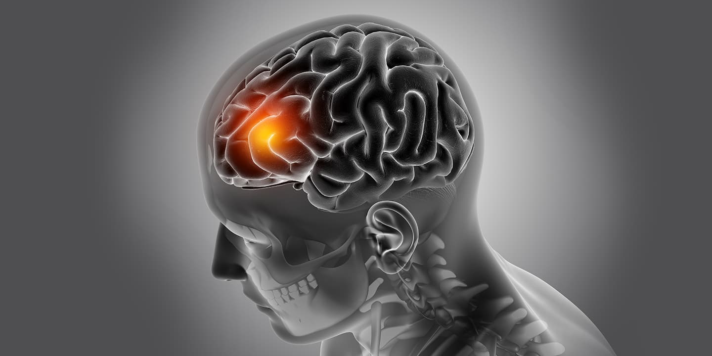 Brain Tumour: Causes, Symptoms and Treatment