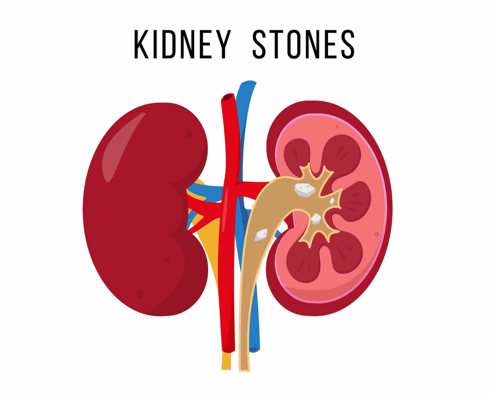 Kidney Stone Symptoms in Marathi