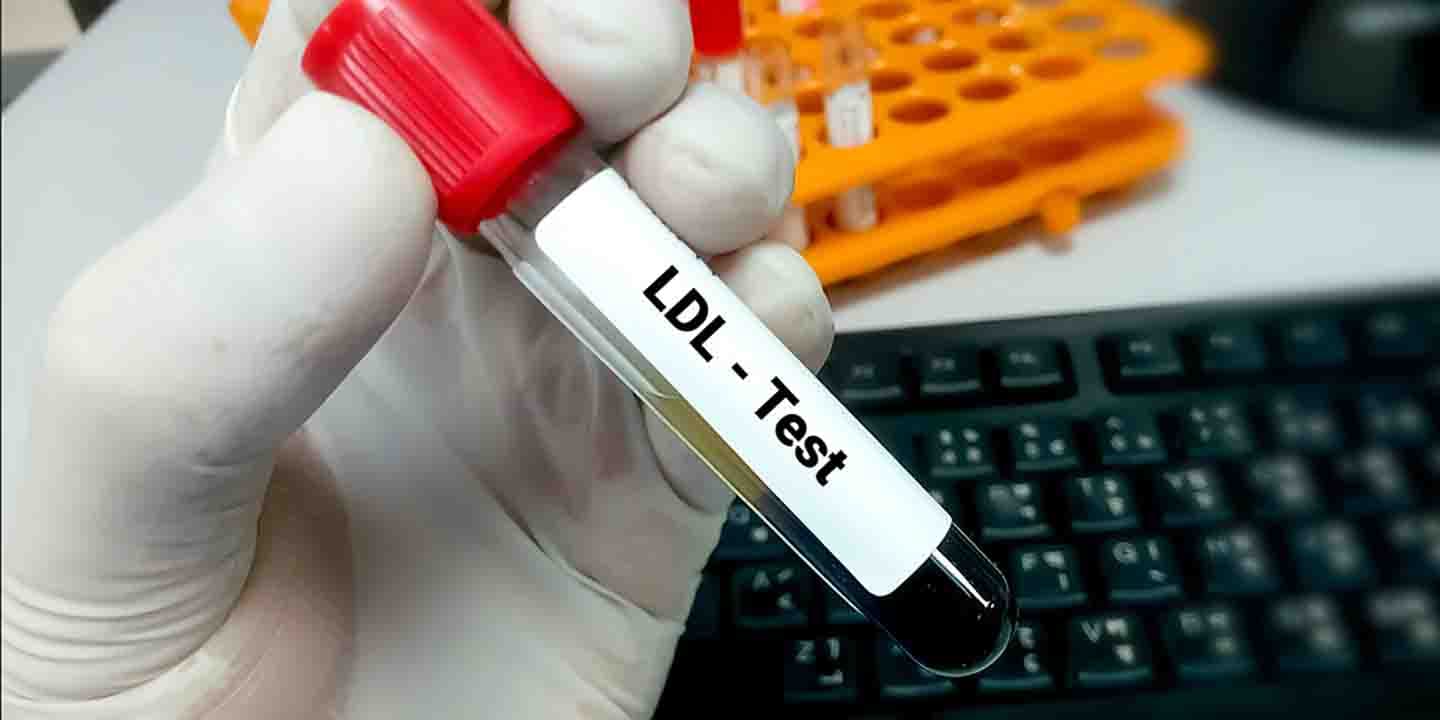 Lipoprotein-Blood-Test