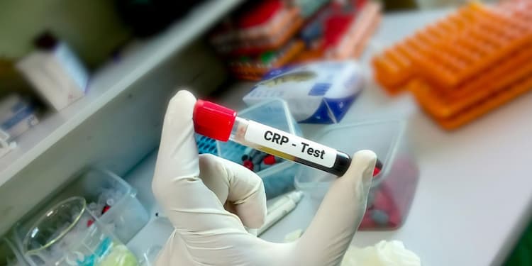 HS-CRP Test - Price, Causes, Risk Factors, & Treatment