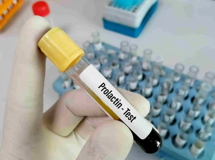All You Need to Know about the Prolactin Test