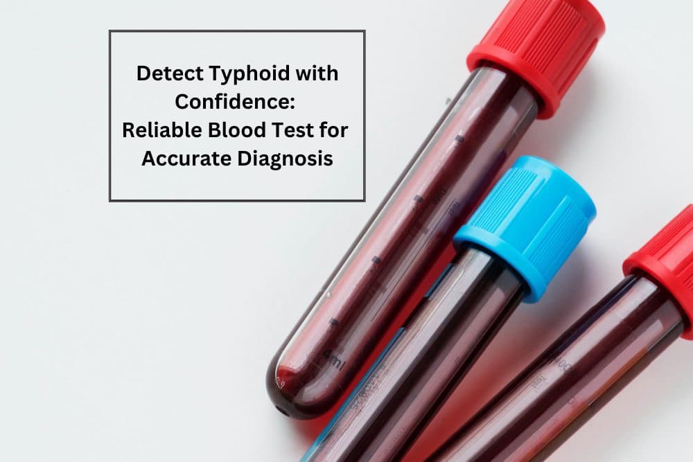 Blood Test For Typhoid