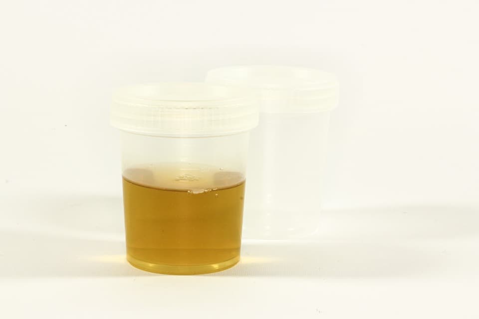 Epithelial Cells in Urine: normal range