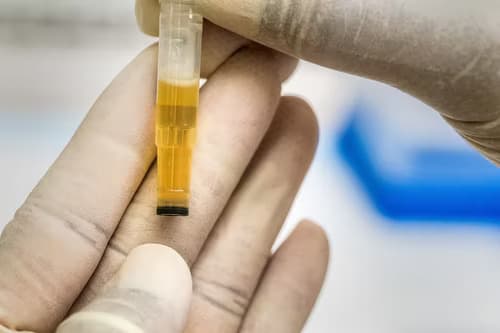uric acid test in india