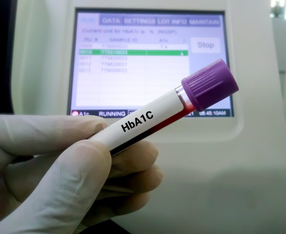 What is the Best Time for HbA1c Test?