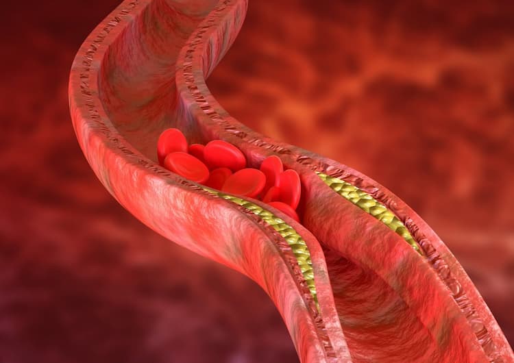 How Your Limbs Warn You About High Cholesterol