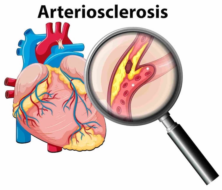 Types of Arteriosclerosis Cause Symptoms & Management with Early Diagnosis