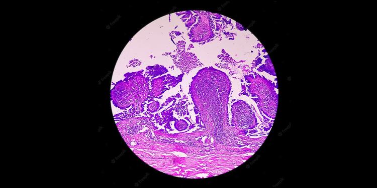 Epithelial Cells in Urine: Normal Range, Treatment, Risk Factors