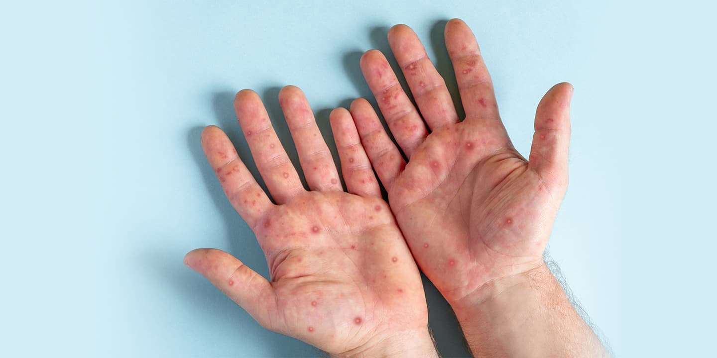 Are-monkeypox-scars-permanent
