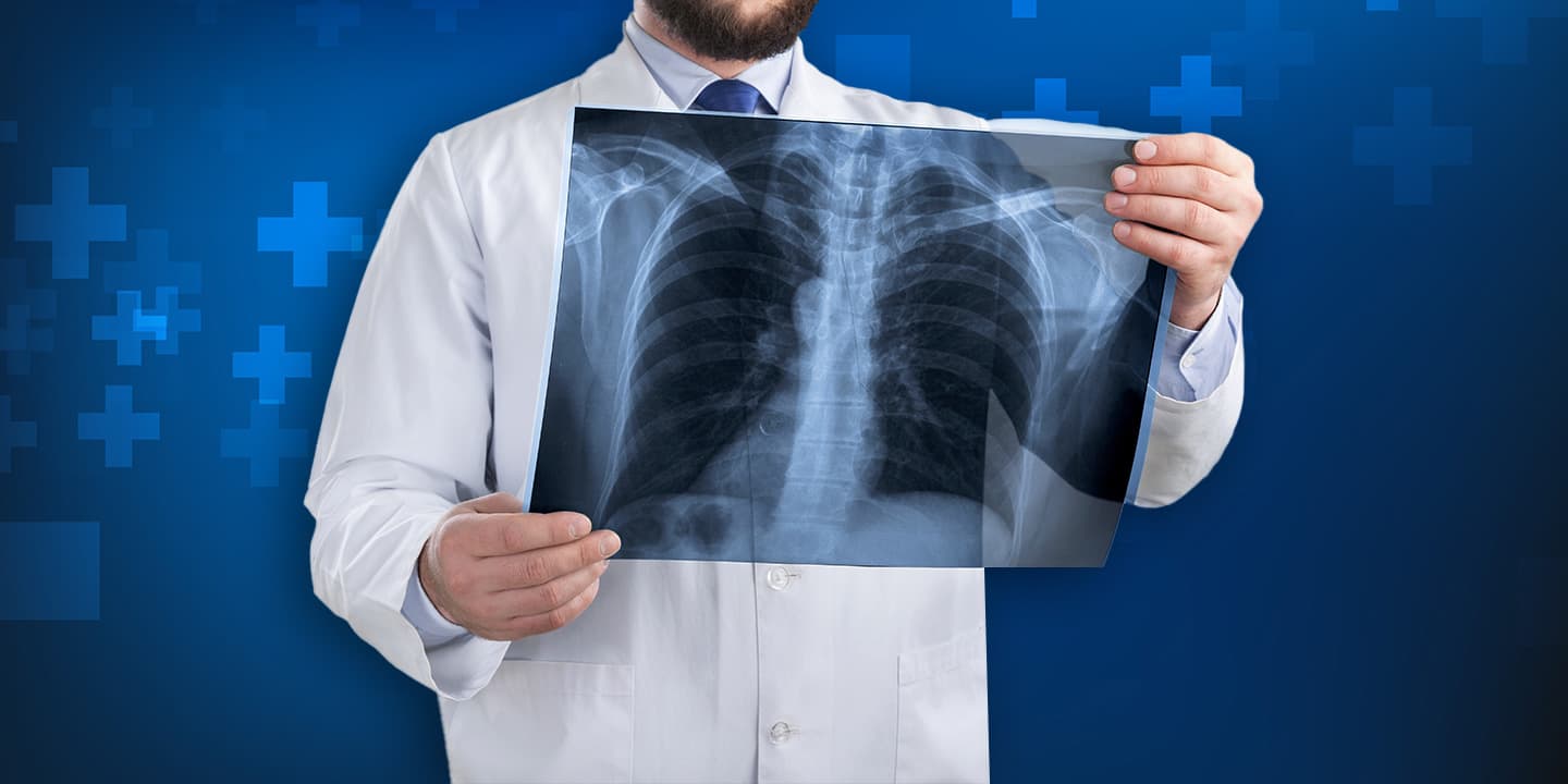 Prominent Bronchovascular Markings in Chest X-Ray