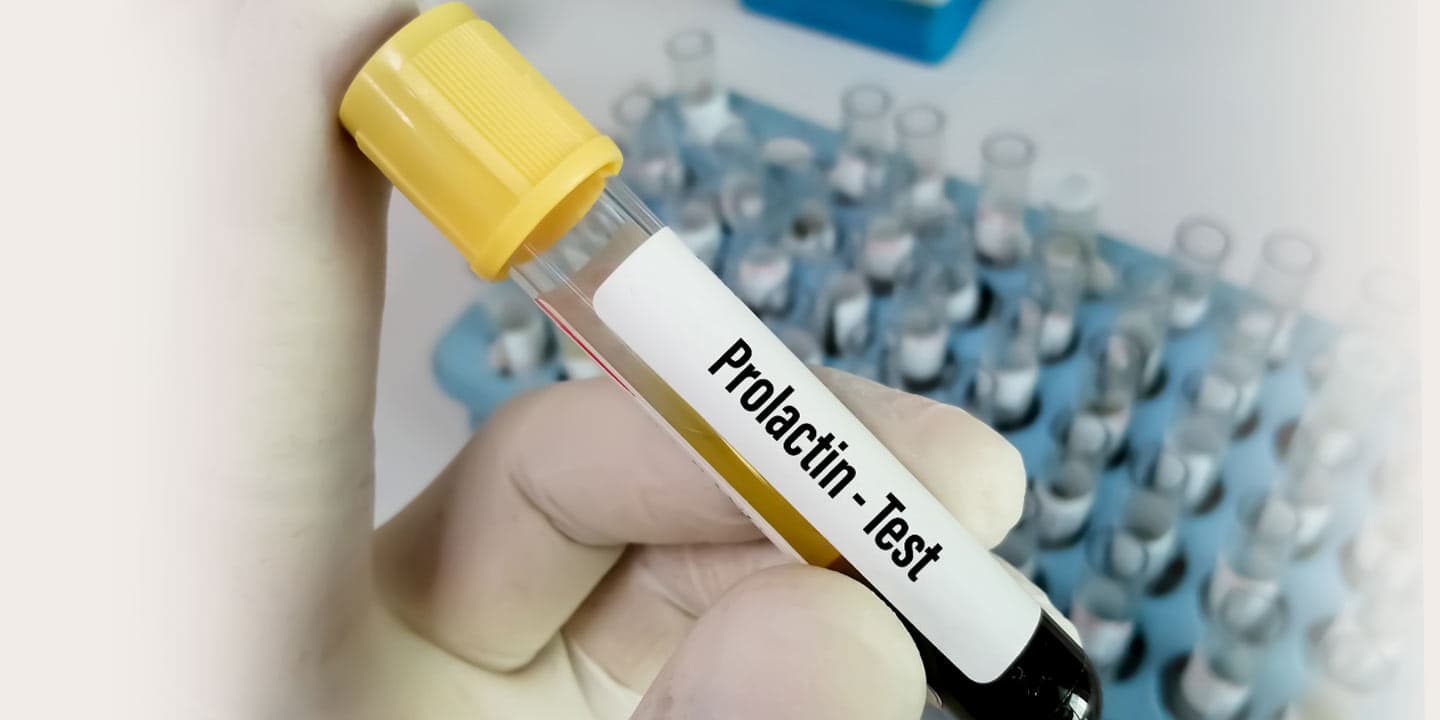Prolactin-Test