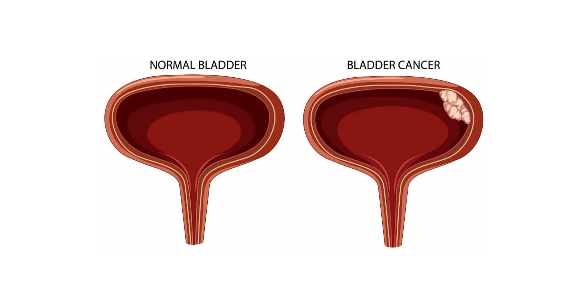 What Is Bladder Cancer, Symptoms, Treatment
