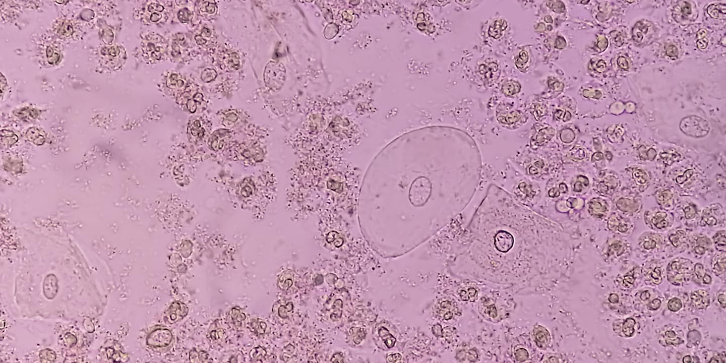 Pus-Cells-in-Urine