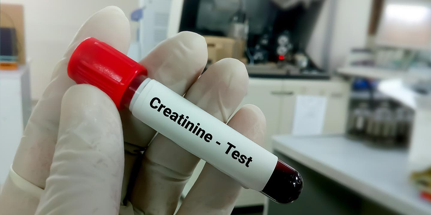 Serum creatinine and its normal range in bengali
