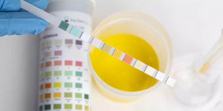 প্রস্রাব সংস্কৃতি বা ইউরিন কালচার