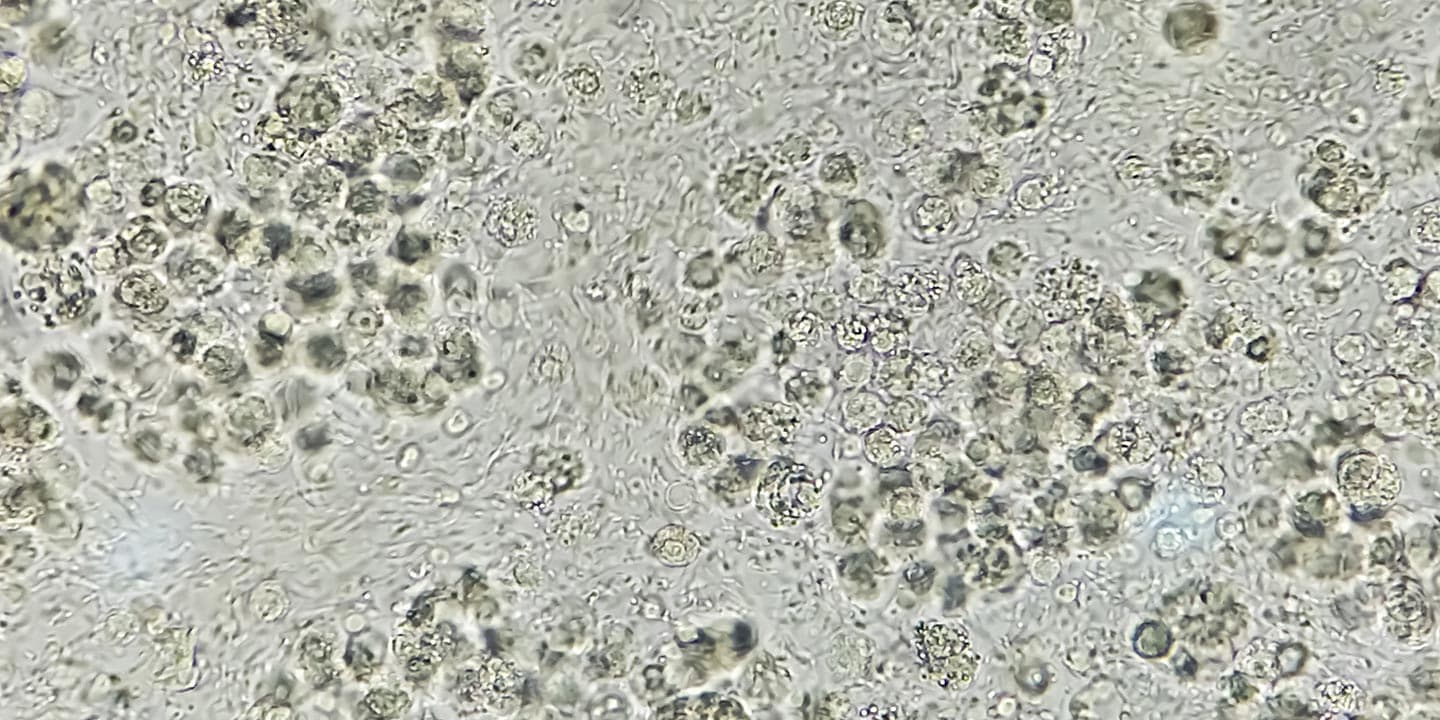 Pus-cells-in-urine-Is-it-normal
