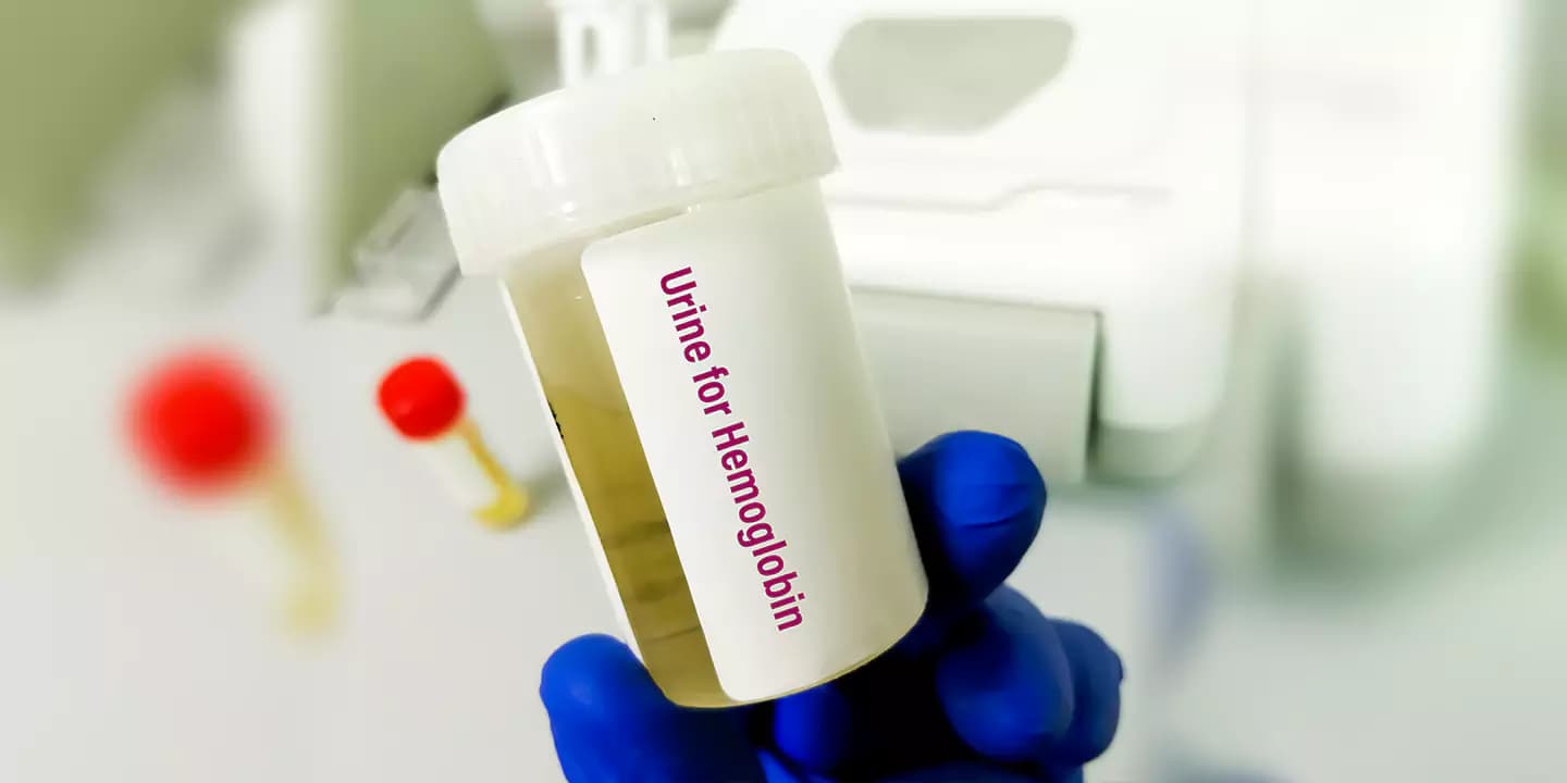 Epithelial Cells in Urine-Normal Values Range, What do the Results Indicate
