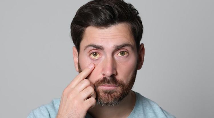 Jaundice Meaning in Hindi: जानें जॉन्डिस के लक्षण, कारण, और उपचार
