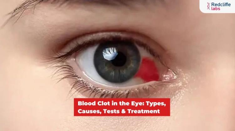 Blood Clot in the Eye: Types, Causes, Tests & Treatment