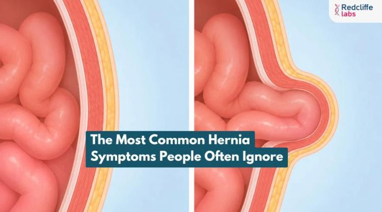 The Most Common Hernia Symptoms People Often Ignore