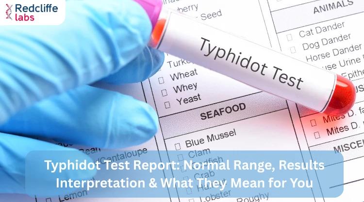 Typhidot Test Report: Normal Range, Results Interpretation & What They Mean for You