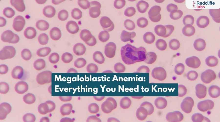 https://myhealth-redcliffelabs.redcliffelabs.com/media/blogcard-images/None/21f9465f-bb81-476e-9053-b4ef861a4ab0.webp