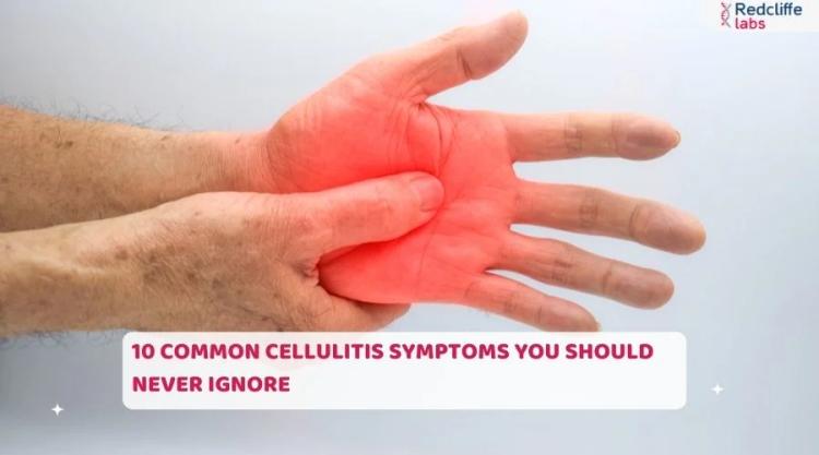 10 Common Cellulitis Symptoms You Should Never Ignore