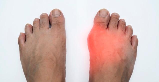 Uric Acid Treatment at Home | Natural Remedies