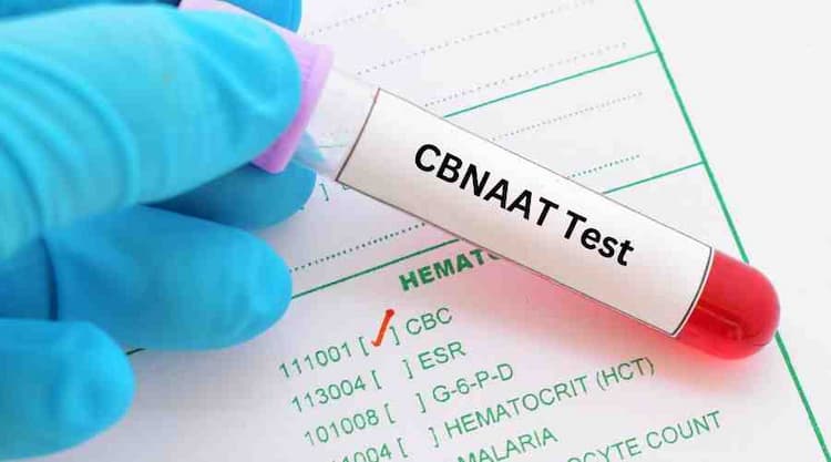 CBNAAT Test in Hindi, क्या होता है? क्यों, और कब करना चाहिए