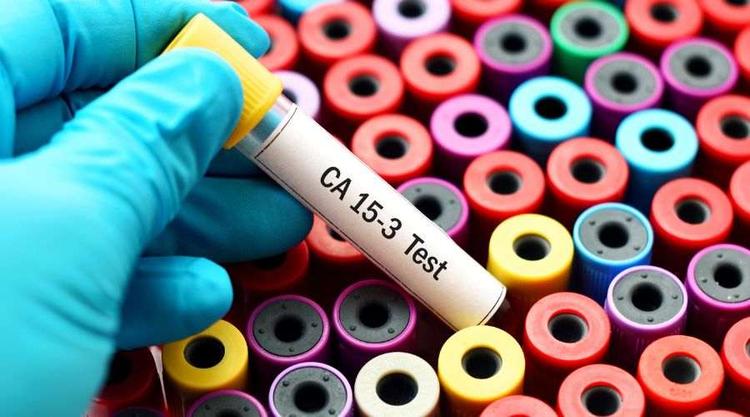 What Can Cause CA 15-3 to Rise? Check the Details