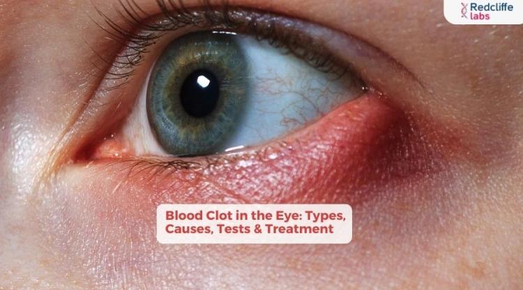 Blood Clot in the Eye: Types, Causes, Tests & Treatment
